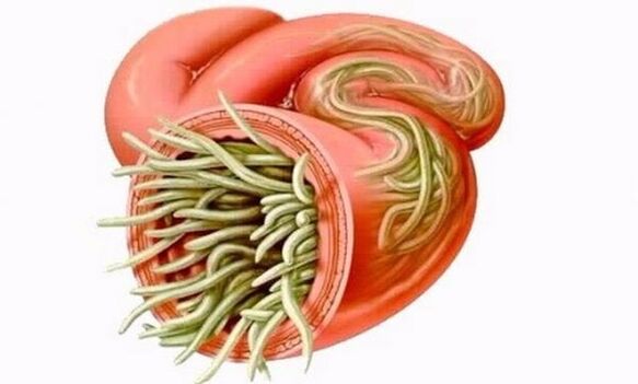gusanos en el intestino humano